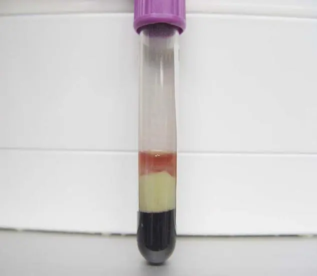 Enfermedades de la sangre Leucocitosis leucemia sangre hiperleucocitosis leucemia mieloide crónica