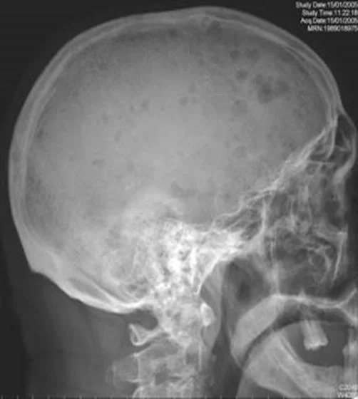 Enfermedades de la sangre Mieloma múltiple osteólisis