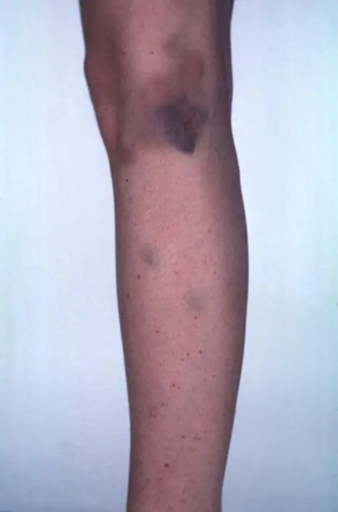 Enfermedades de la sangre Equimosis y petequias morados coagulación
